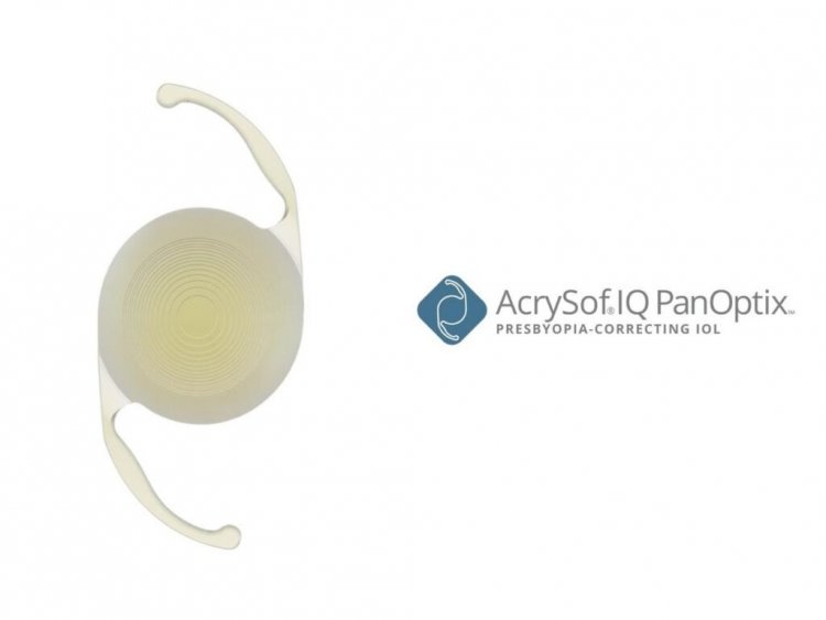 PanOptix Trifocal Intraocular Lens Surpasses One Million Implants Worldwide